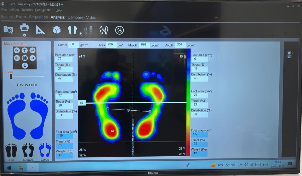 Cavus Feet, Teknofeet Airia Mall